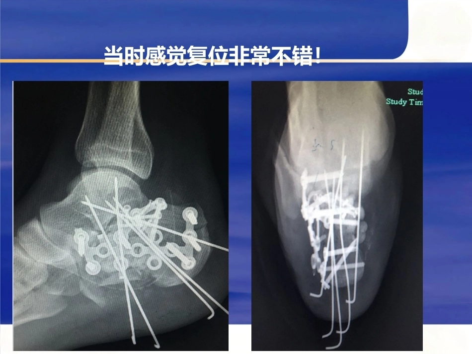 微创跟骨 骨折新_第9页