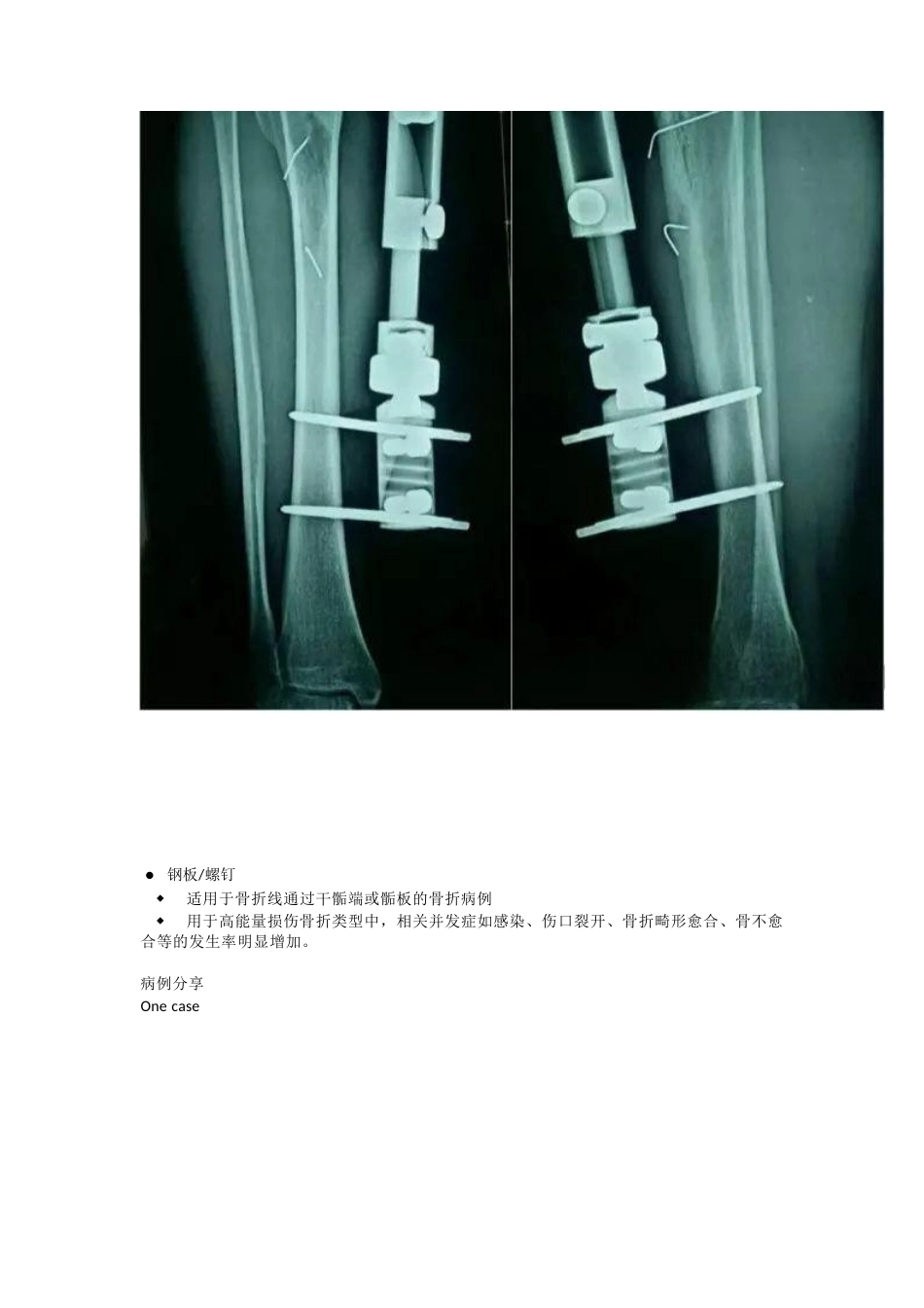 胫腓骨骨折的治疗 方法_第14页