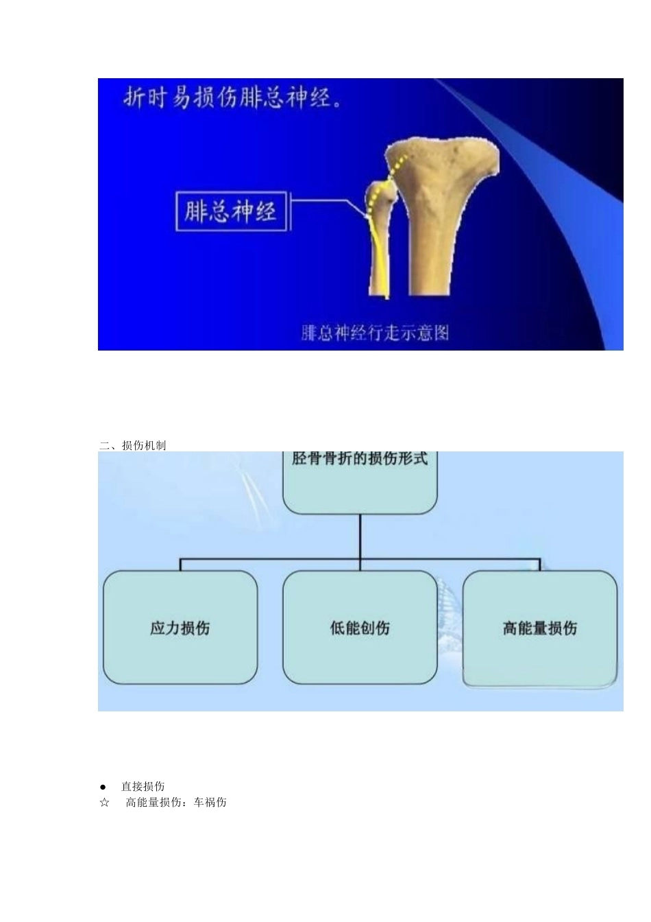 胫腓骨骨折的治疗 方法_第4页