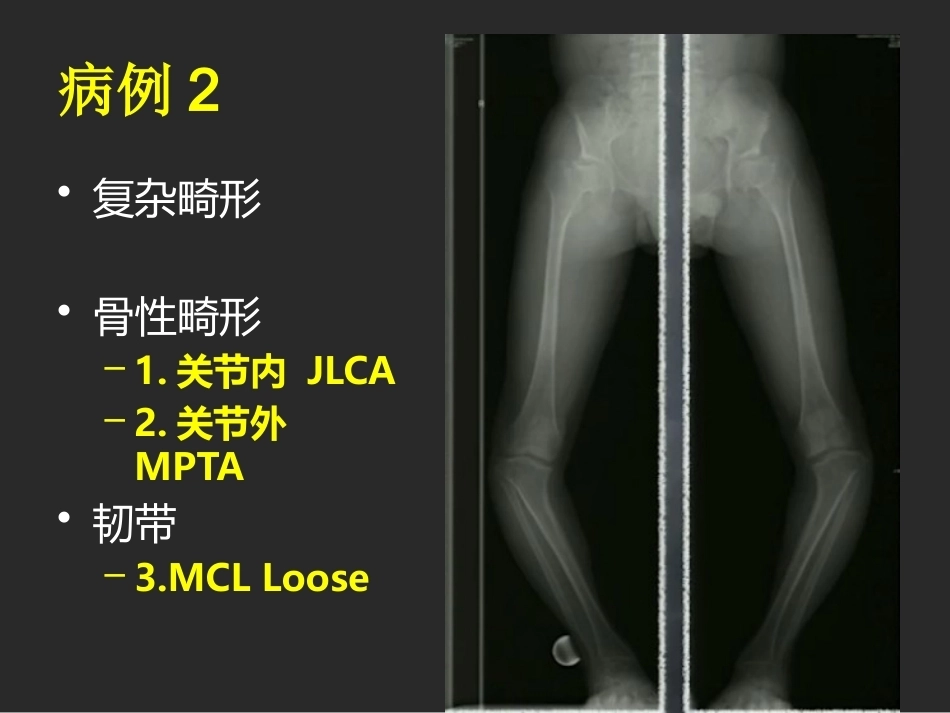 下肢截骨的 基本原则_第15页