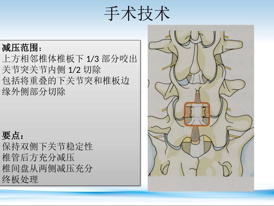 XLIF的技术对比_第11页