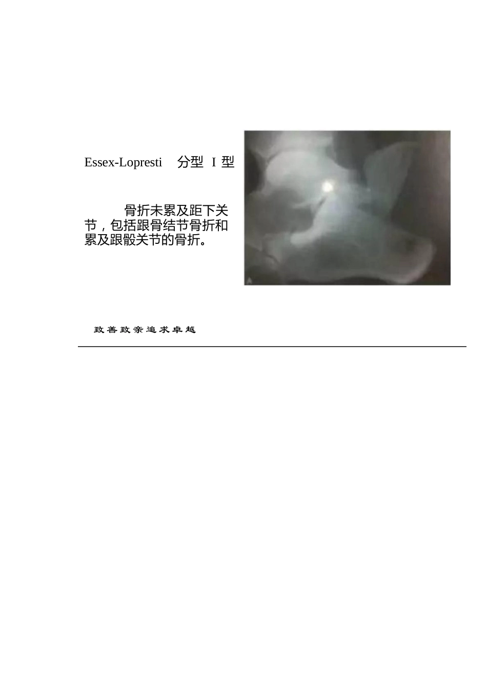跟骨骨折的分型详解_第10页