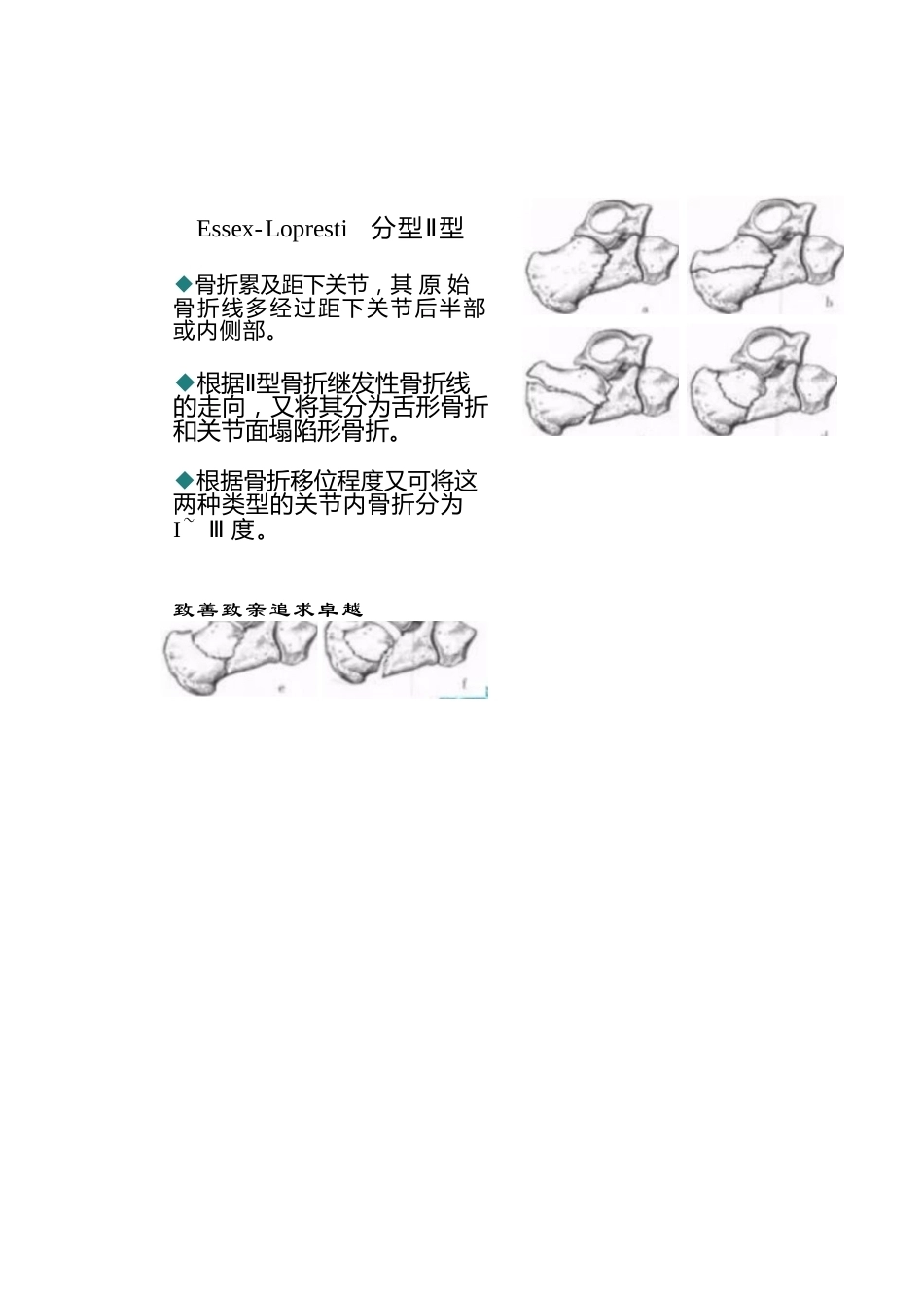 跟骨骨折的分型详解_第11页