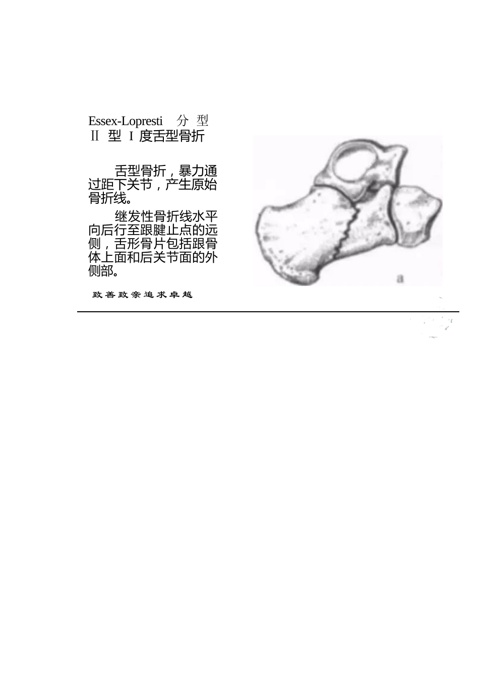 跟骨骨折的分型详解_第12页