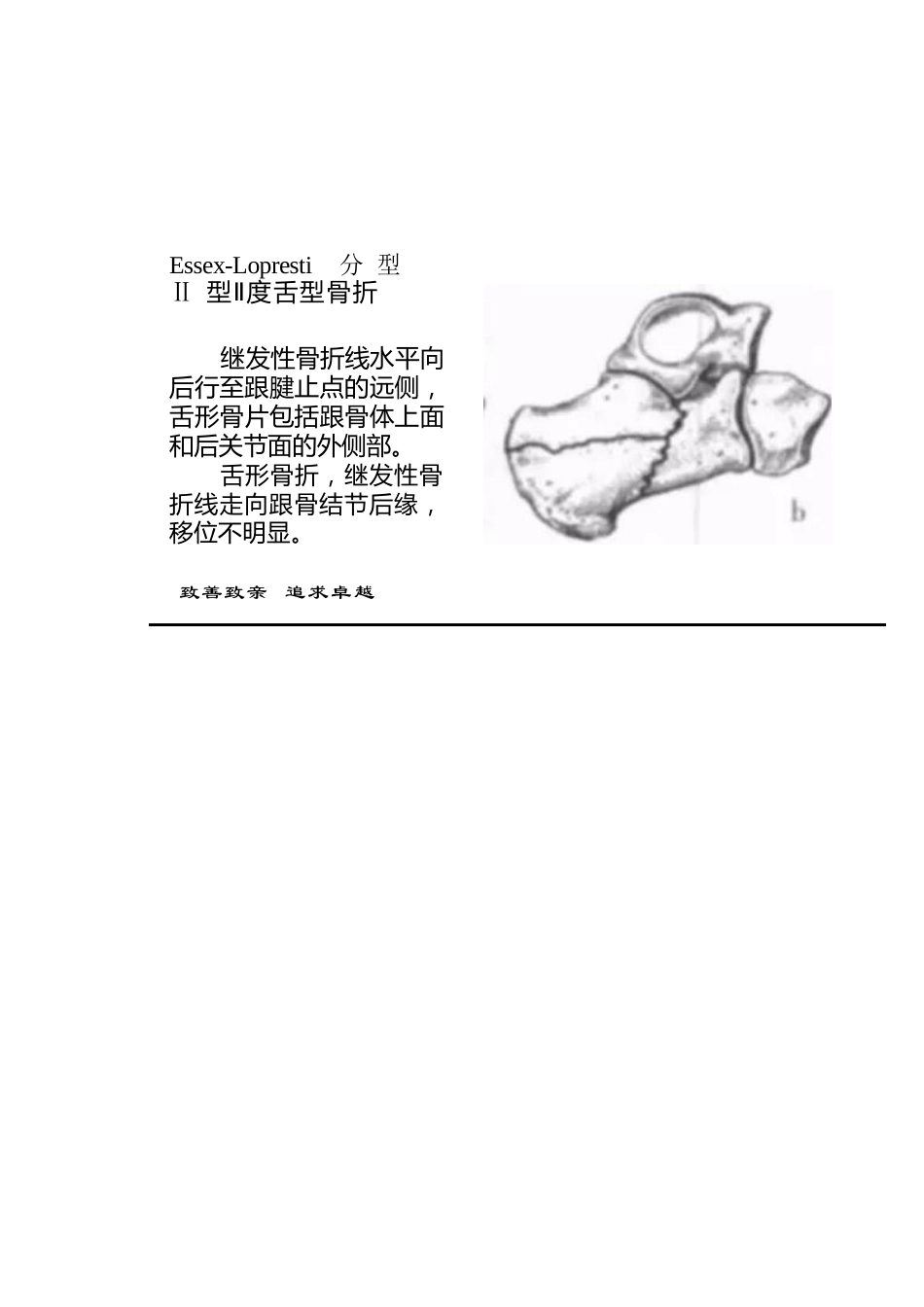 跟骨骨折的分型详解_第13页