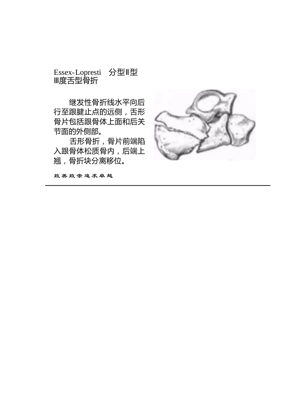 跟骨骨折的分型详解_第14页