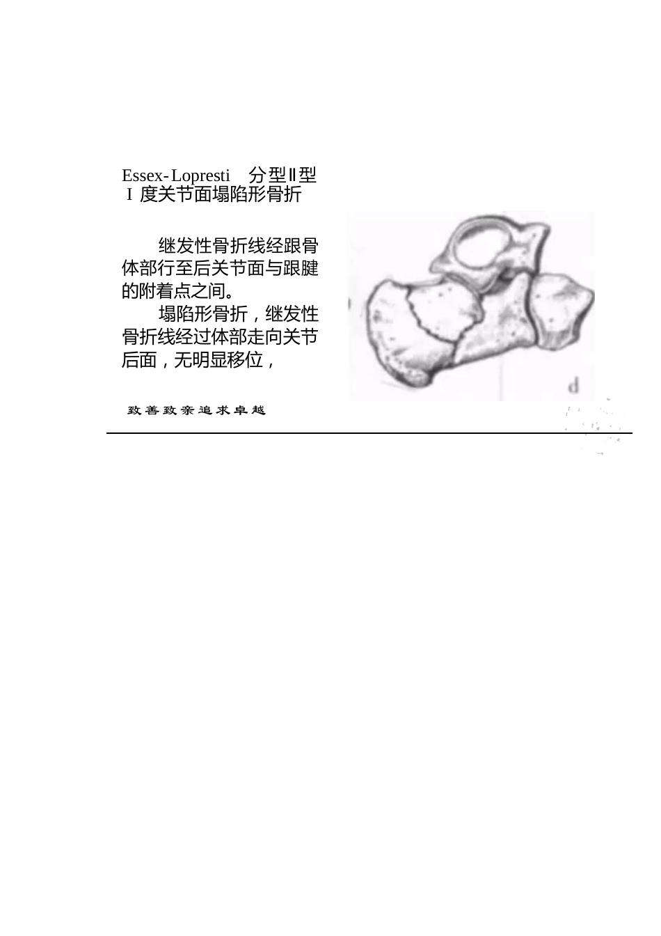 跟骨骨折的分型详解_第15页
