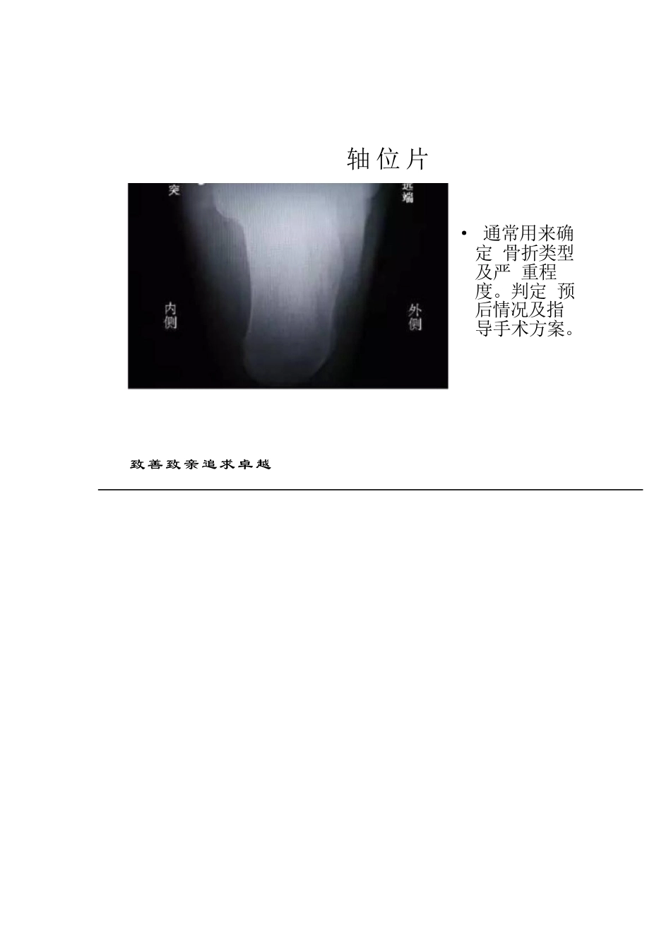 跟骨骨折的分型详解_第4页