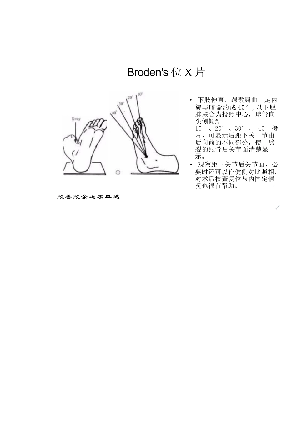 跟骨骨折的分型详解_第5页