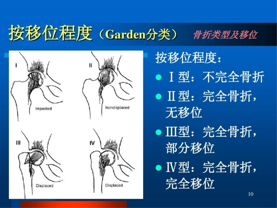 股 骨颈骨折ppt_第10页