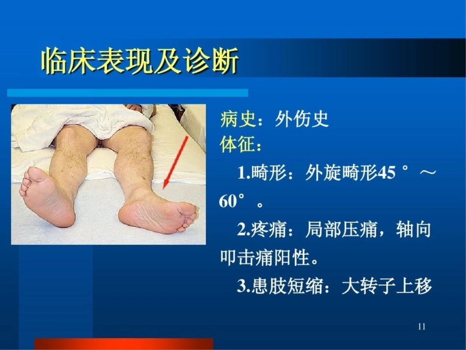 股 骨颈骨折ppt_第11页