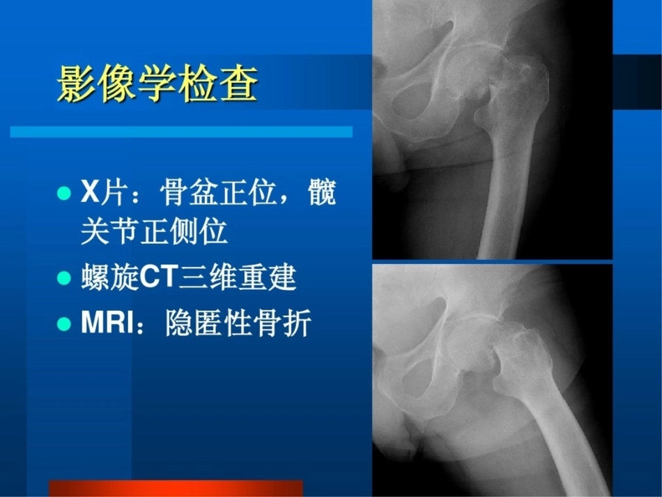 股 骨颈骨折ppt_第13页