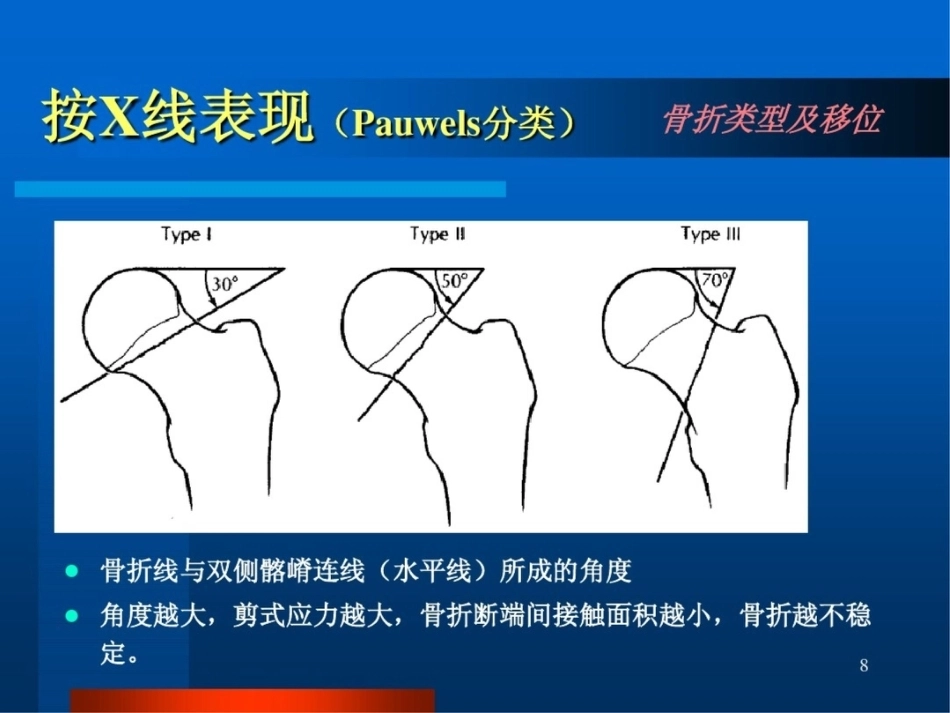 股 骨颈骨折ppt_第8页