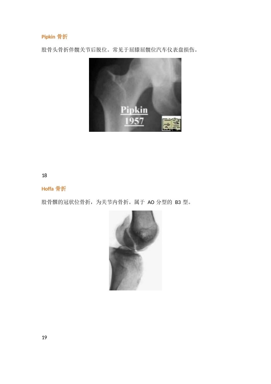三十八种特殊类型的骨折_第10页