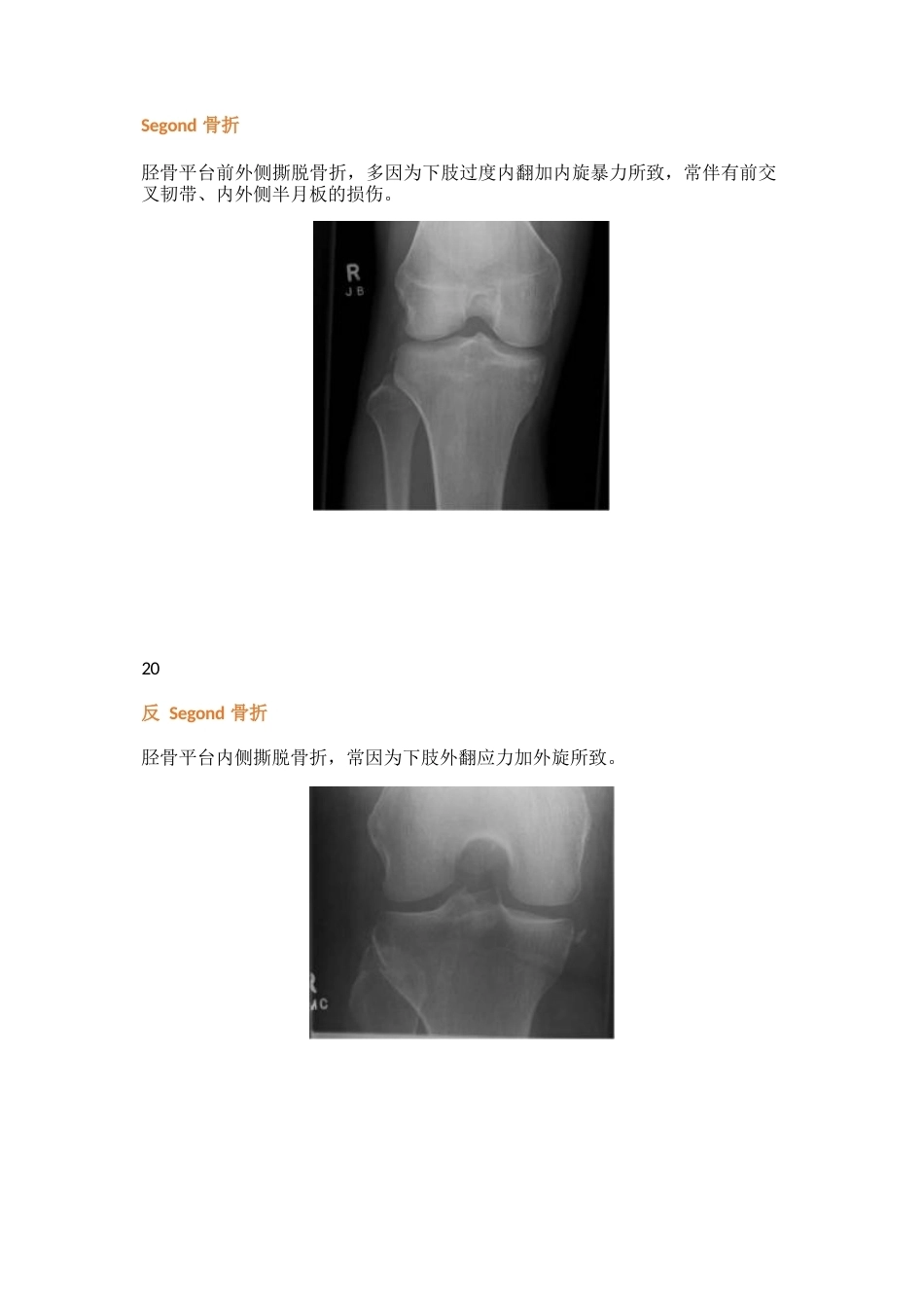 三十八种特殊类型的骨折_第11页