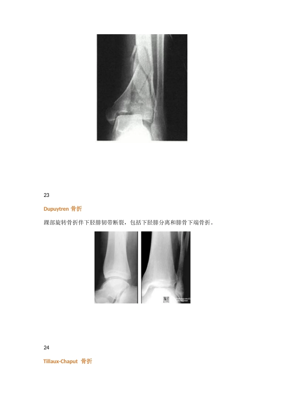 三十八种特殊类型的骨折_第13页