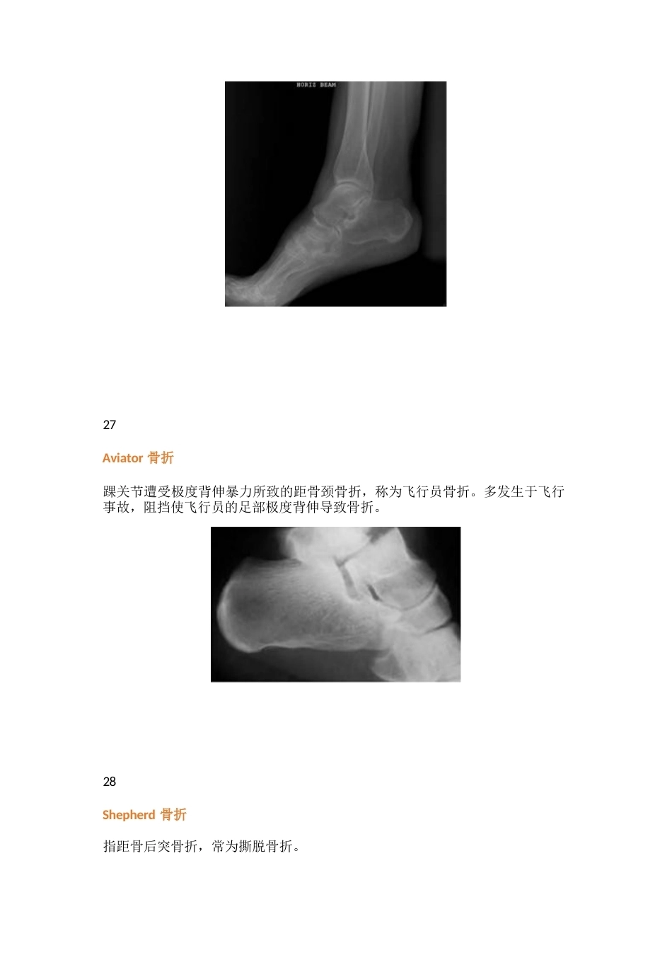 三十八种特殊类型的骨折_第15页