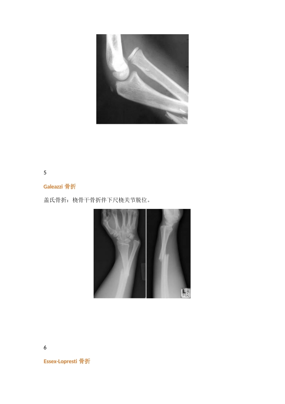 三十八种特殊类型的骨折_第3页