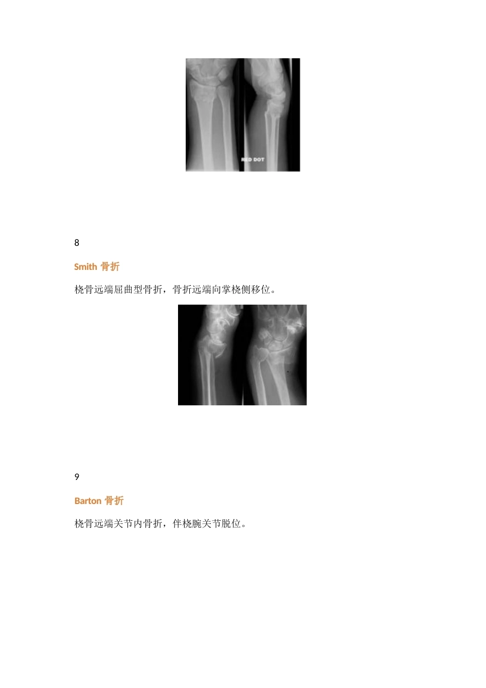 三十八种特殊类型的骨折_第5页