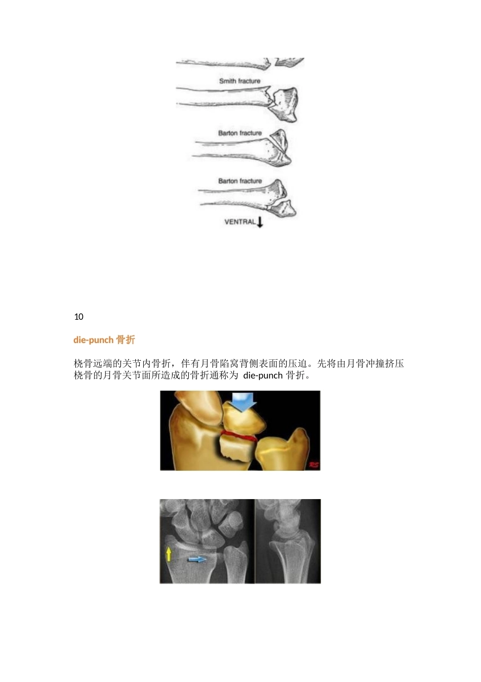 三十八种特殊类型的骨折_第6页