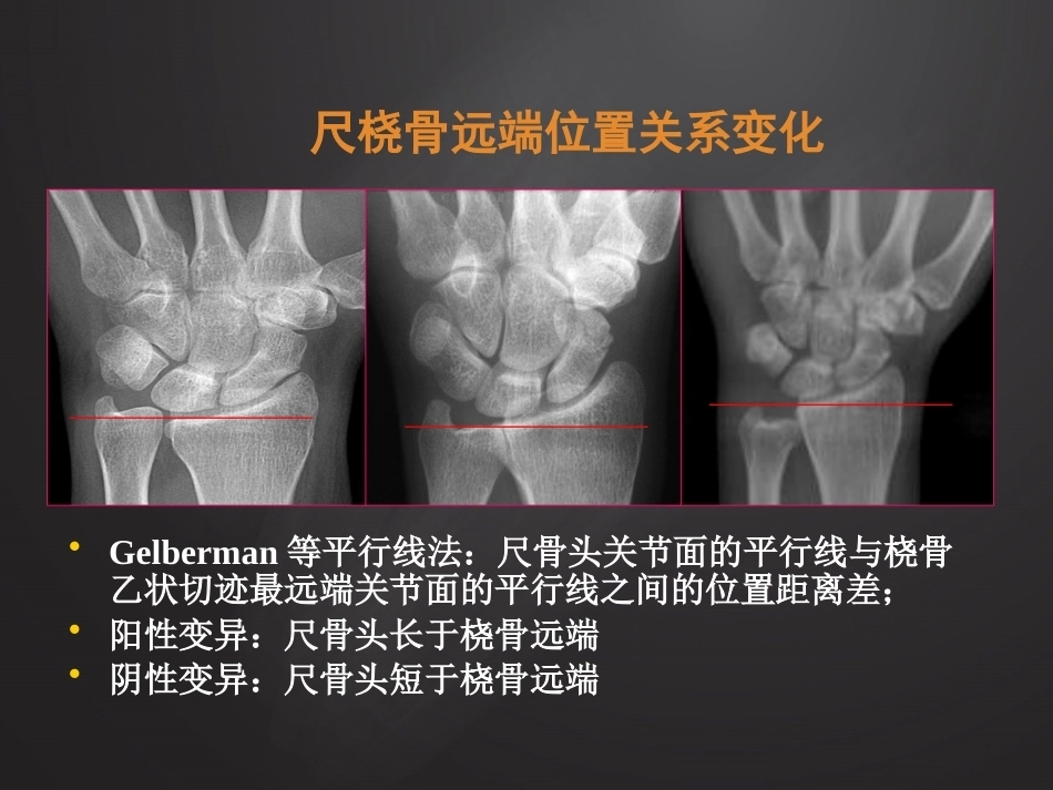 腕关 节损伤MRI诊断_第14页