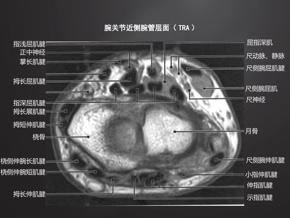 腕关 节损伤MRI诊断_第5页
