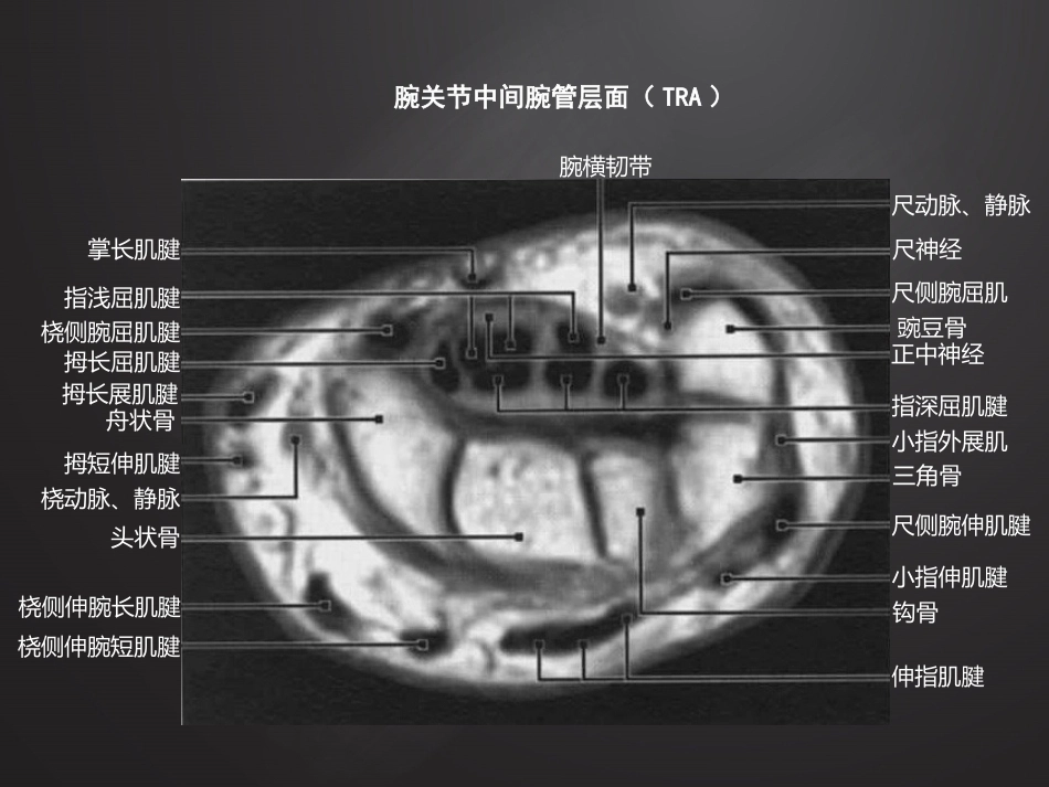 腕关 节损伤MRI诊断_第6页