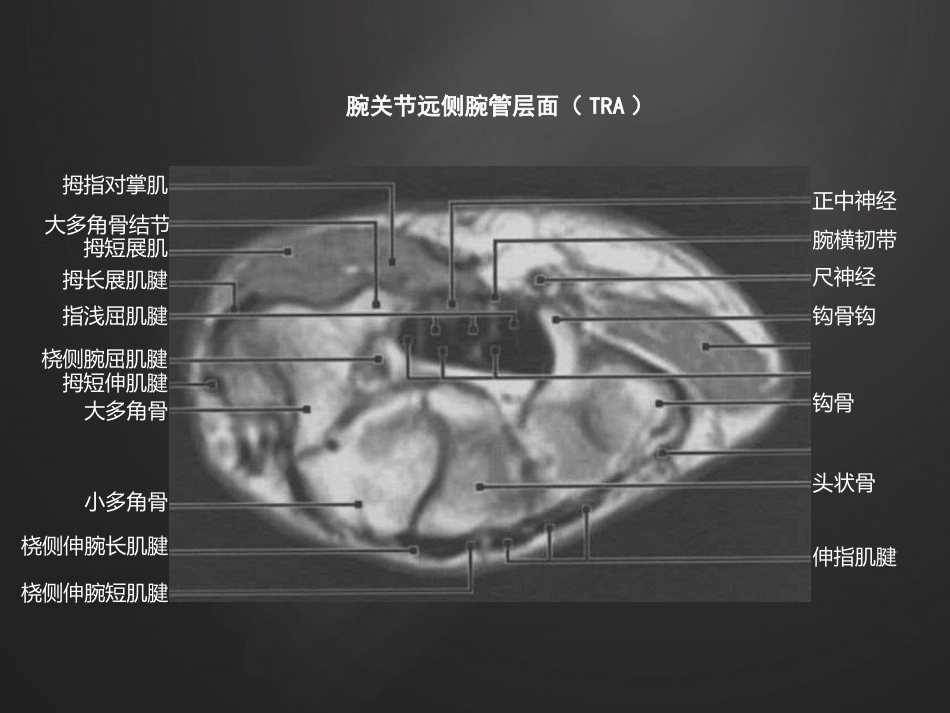 腕关 节损伤MRI诊断_第7页