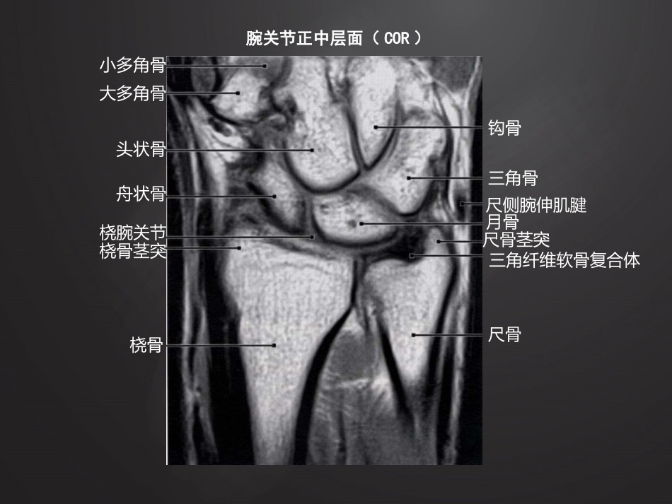腕关 节损伤MRI诊断_第8页