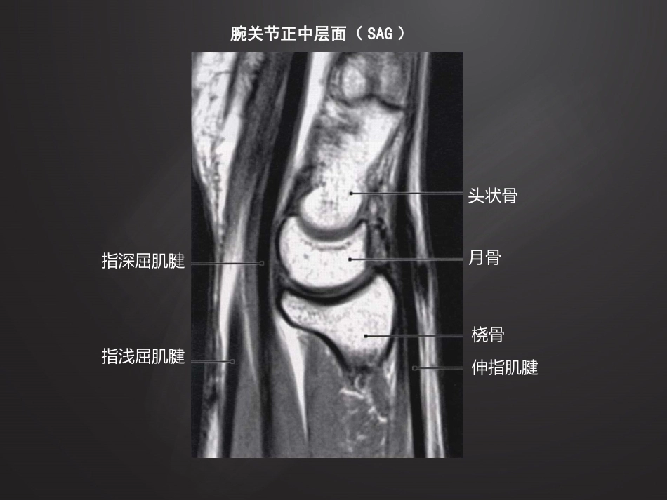 腕关 节损伤MRI诊断_第9页