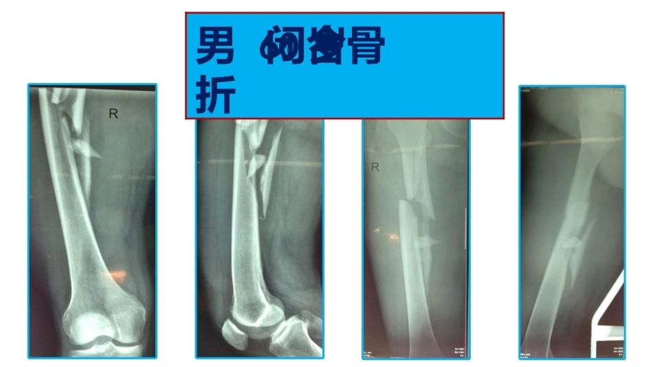 髓内钉远端锁定鸳鸯针技术_第14页