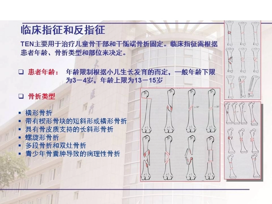 弹性髓内钉治疗儿童 骨折操作技巧_第4页