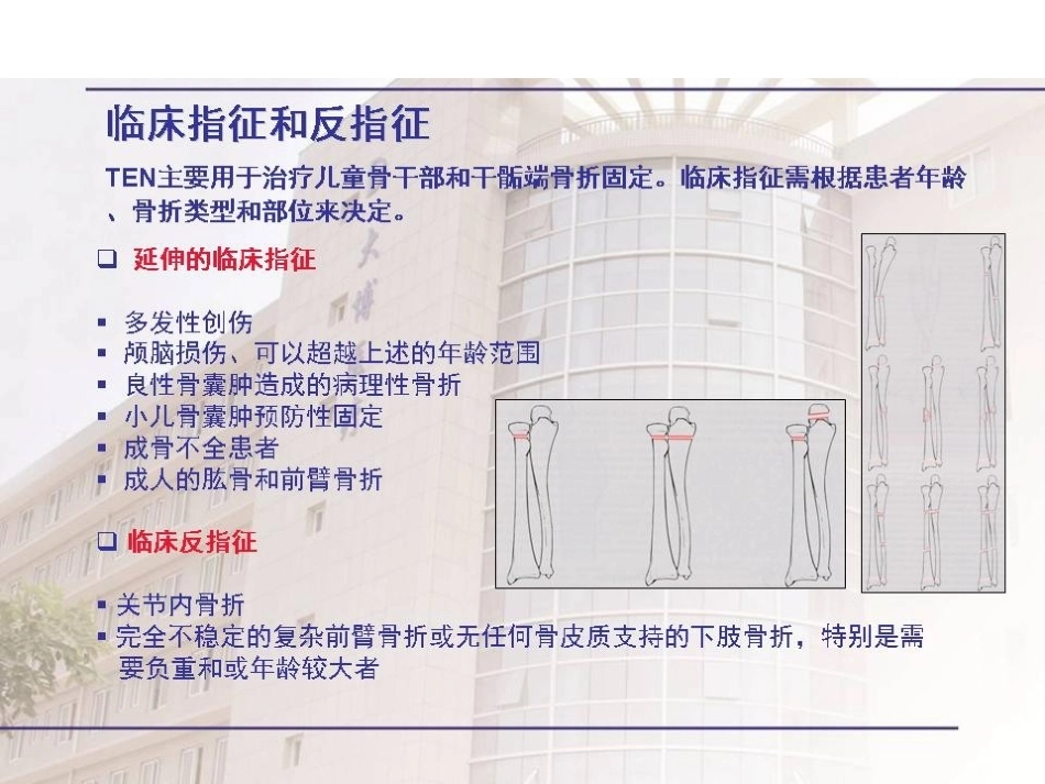 弹性髓内钉治疗儿童 骨折操作技巧_第6页