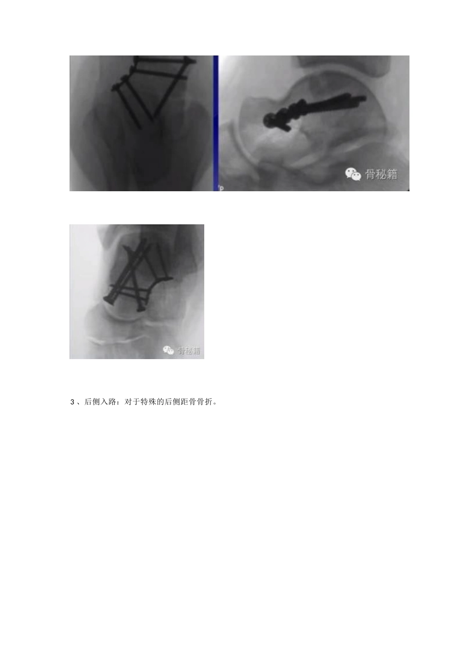 距骨骨折的手术细节 与入路_第8页