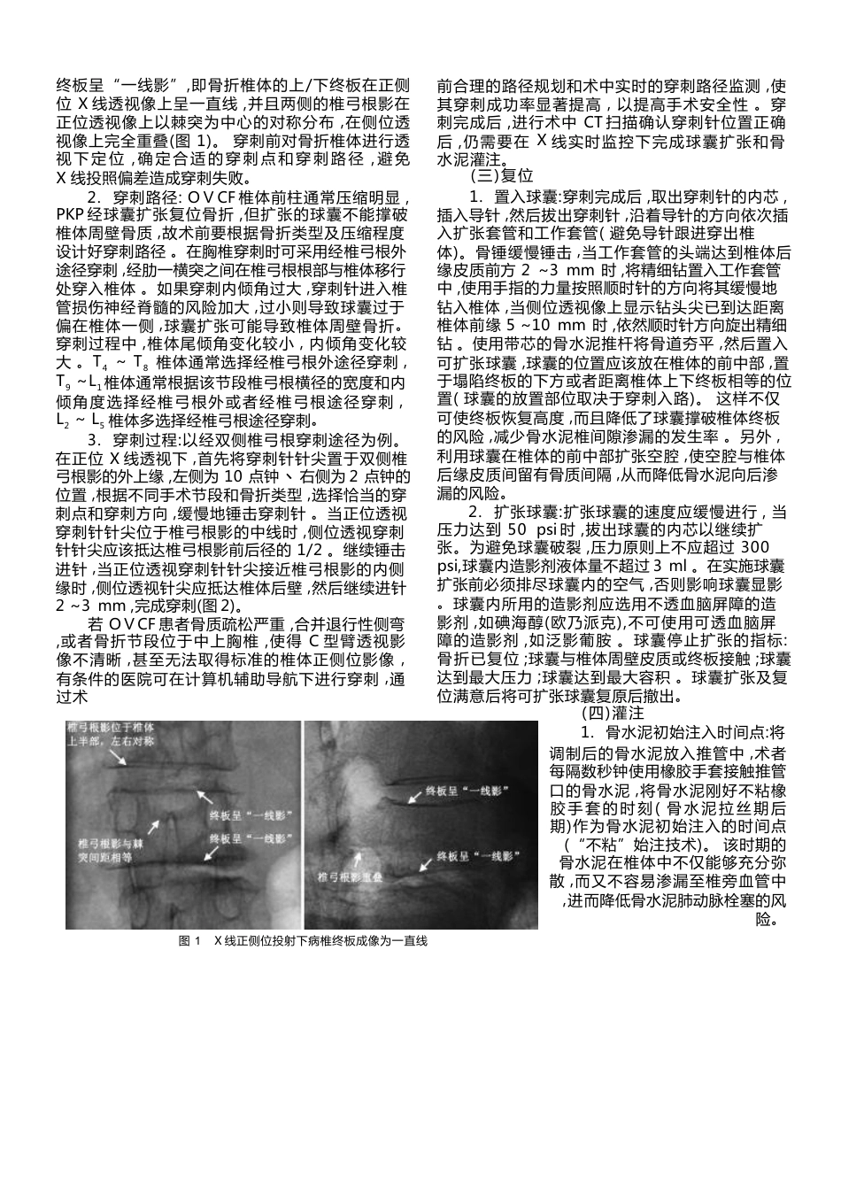 经皮椎体后凸成 形术_第2页