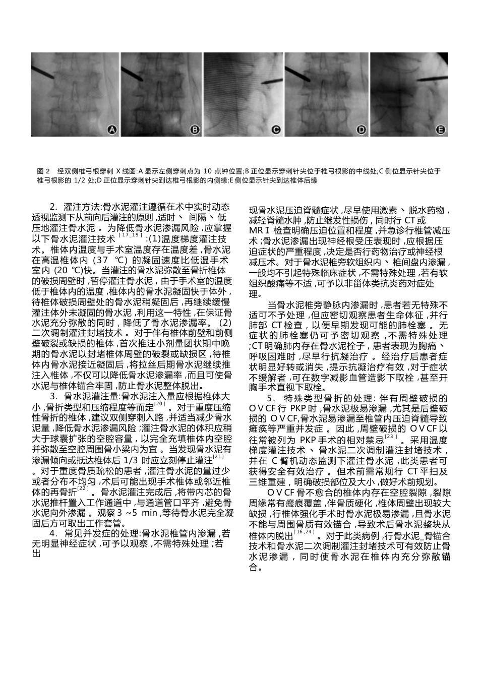 经皮椎体后凸成 形术_第3页