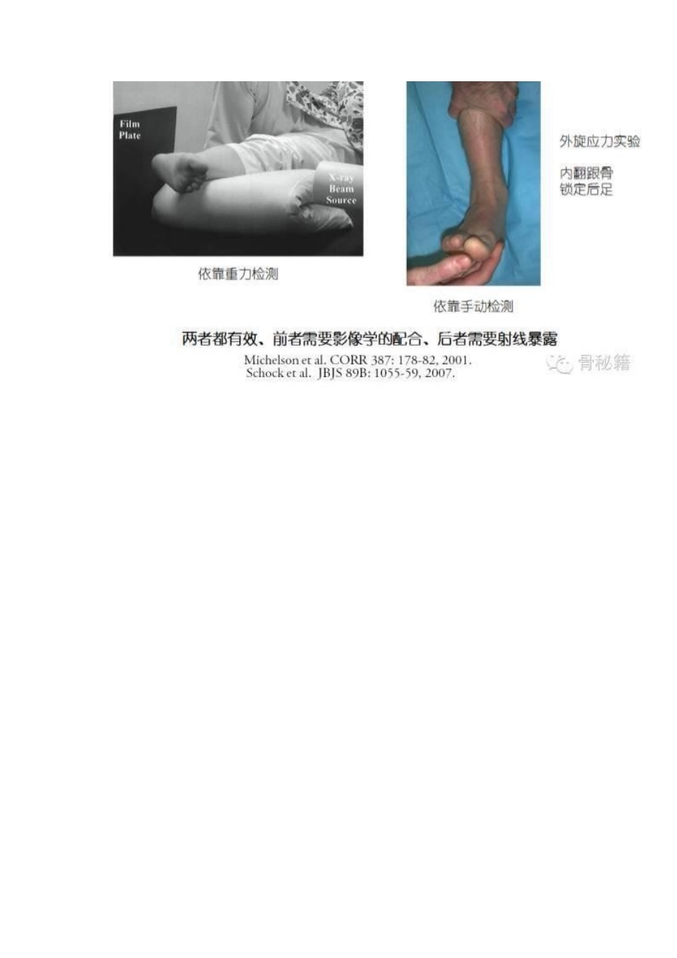 踝关节骨折的治 疗技巧_第10页