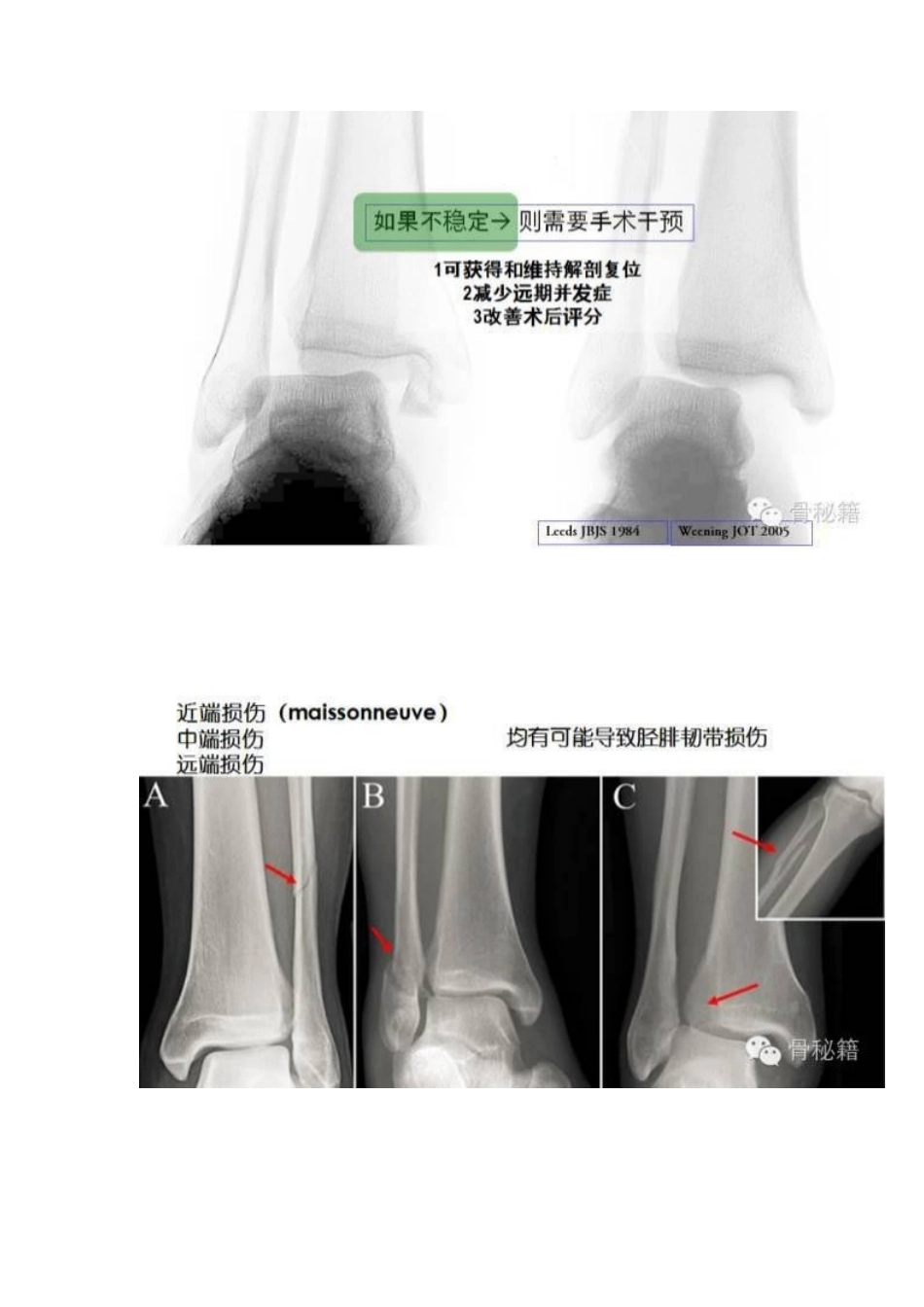 踝关节骨折的治 疗技巧_第12页