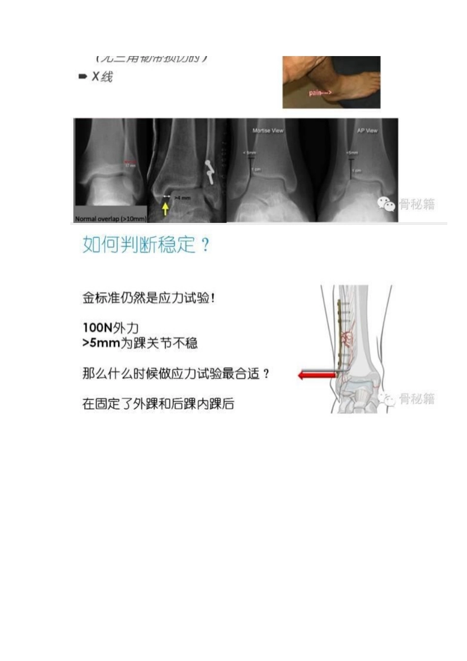 踝关节骨折的治 疗技巧_第13页