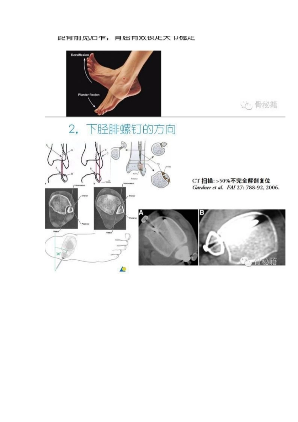 踝关节骨折的治 疗技巧_第14页