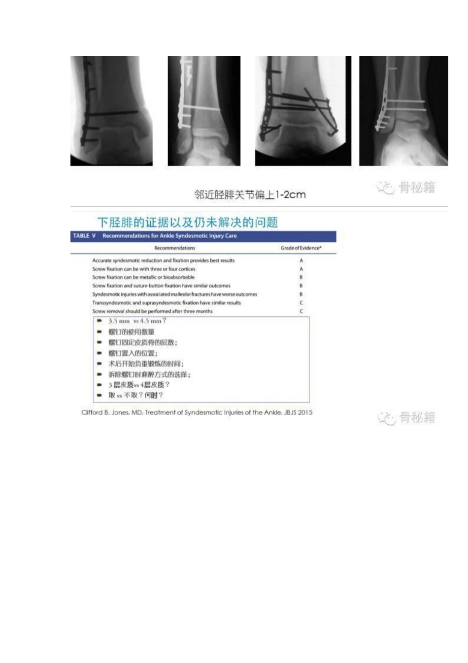 踝关节骨折的治 疗技巧_第15页