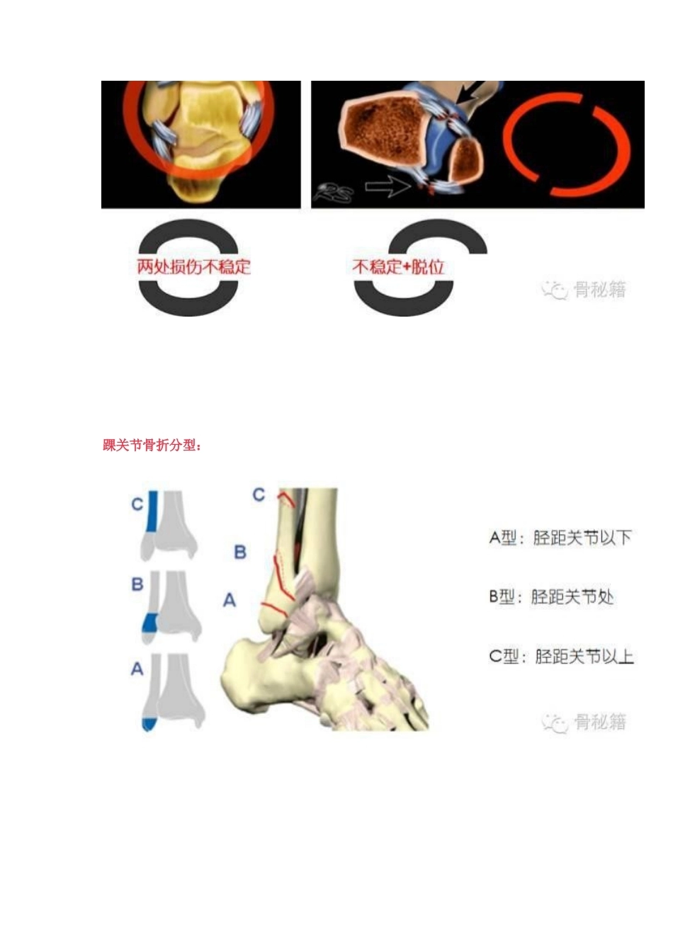 踝关节骨折的治 疗技巧_第2页