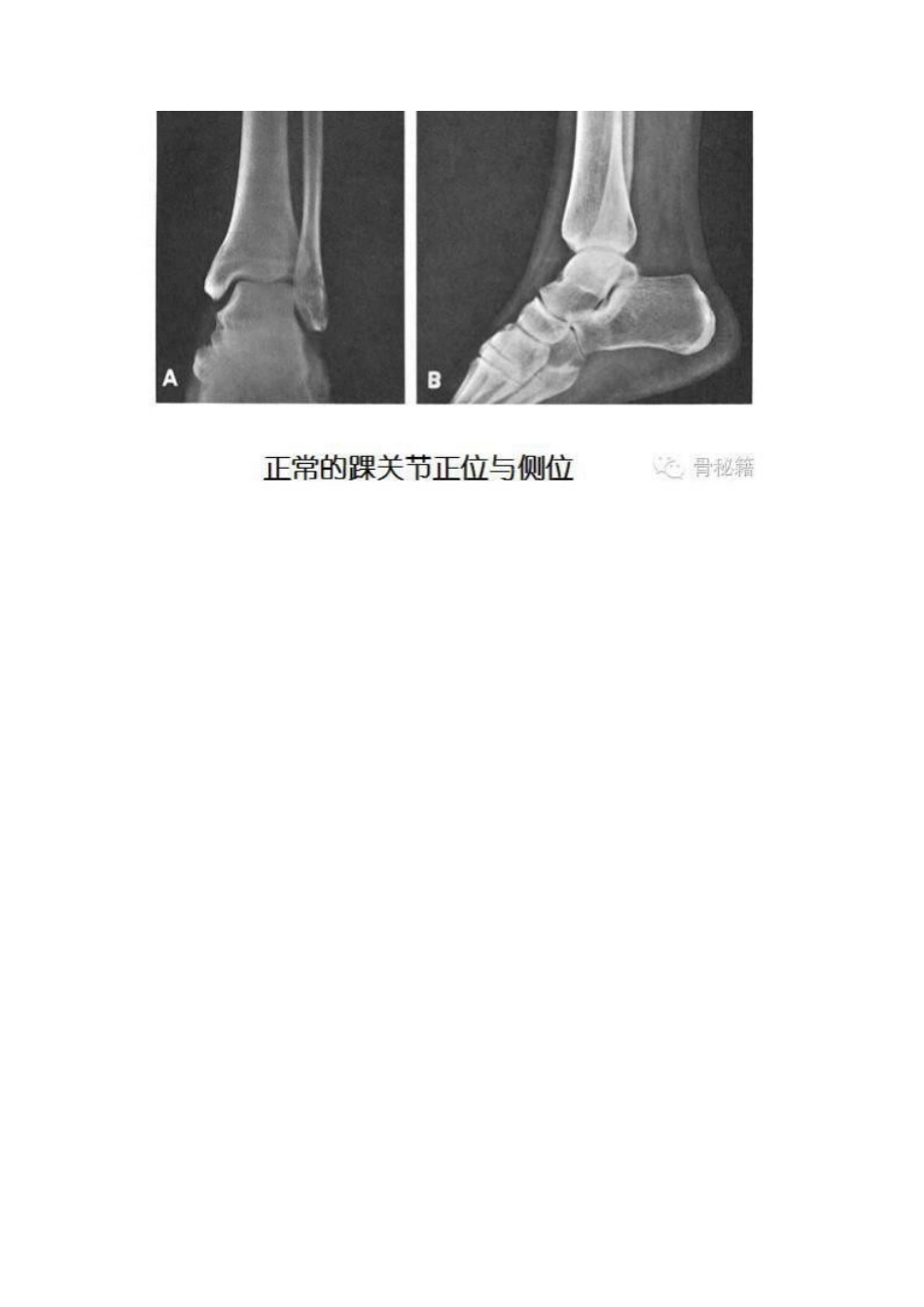 踝关节骨折的治 疗技巧_第5页