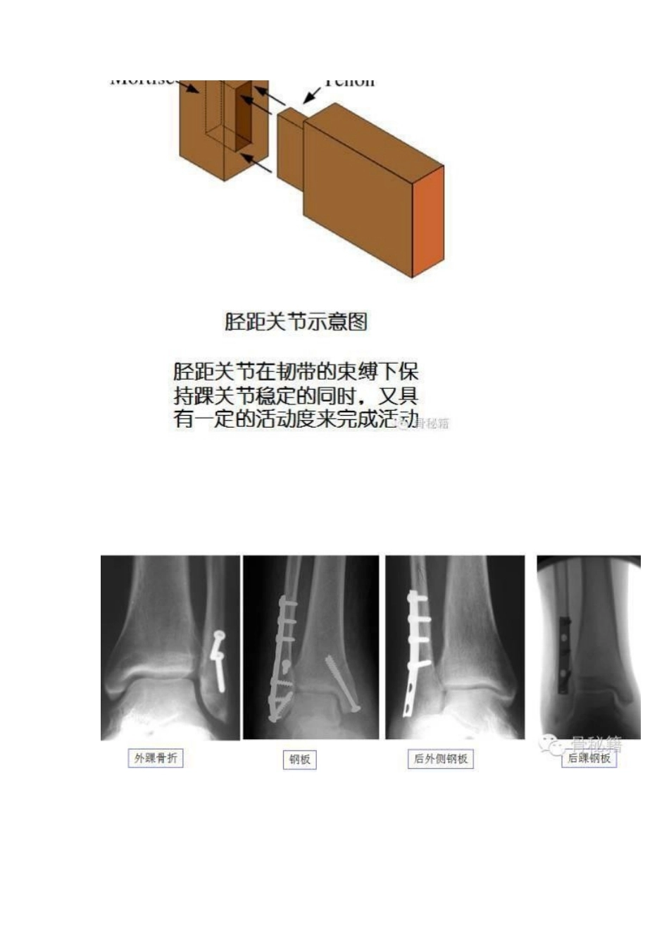 踝关节骨折的治 疗技巧_第6页