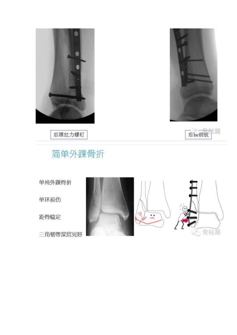 踝关节骨折的治 疗技巧_第8页