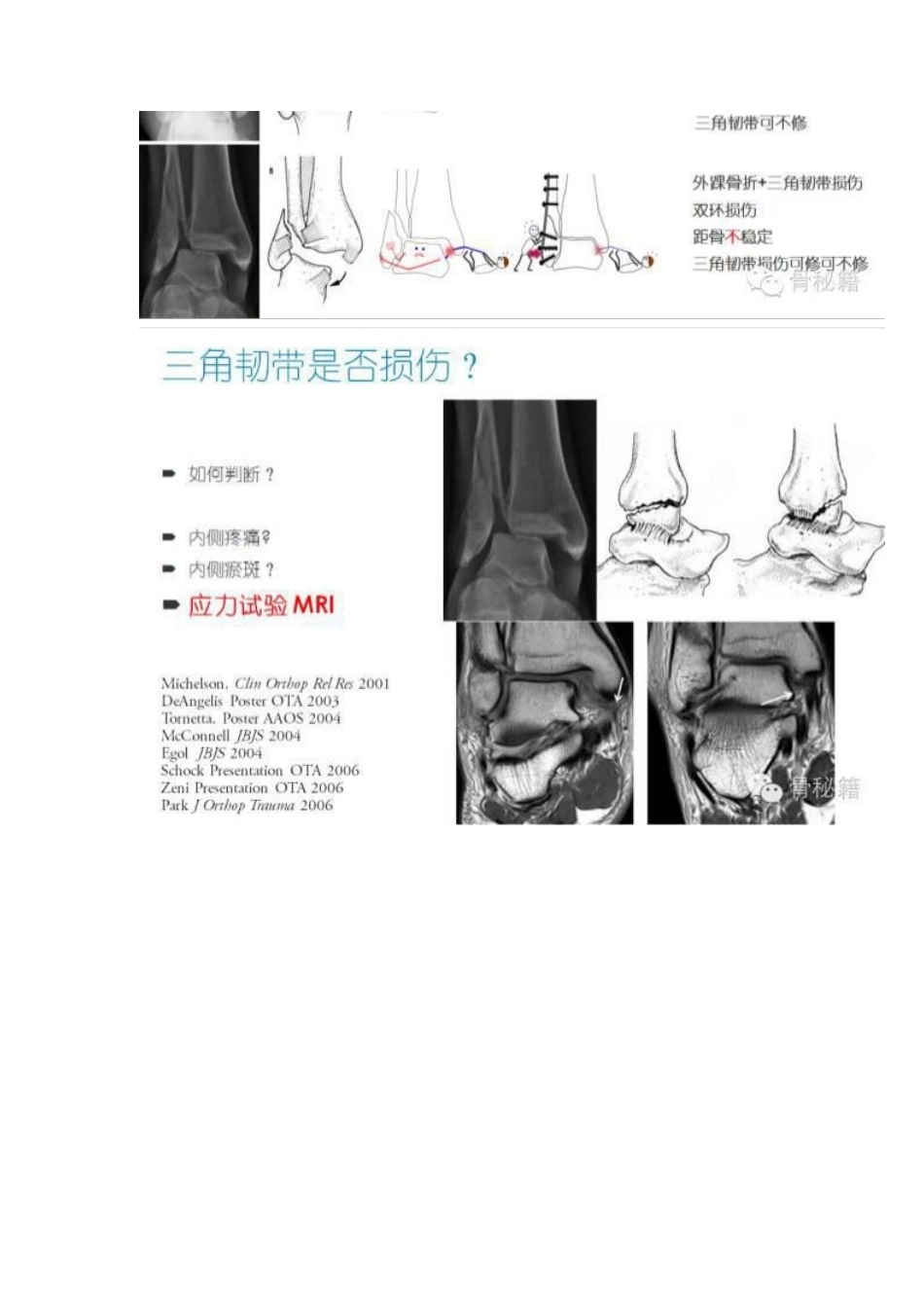 踝关节骨折的治 疗技巧_第9页