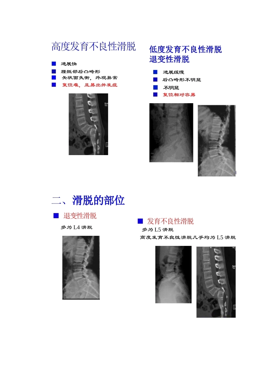 腰椎滑脱的临床分型_第10页