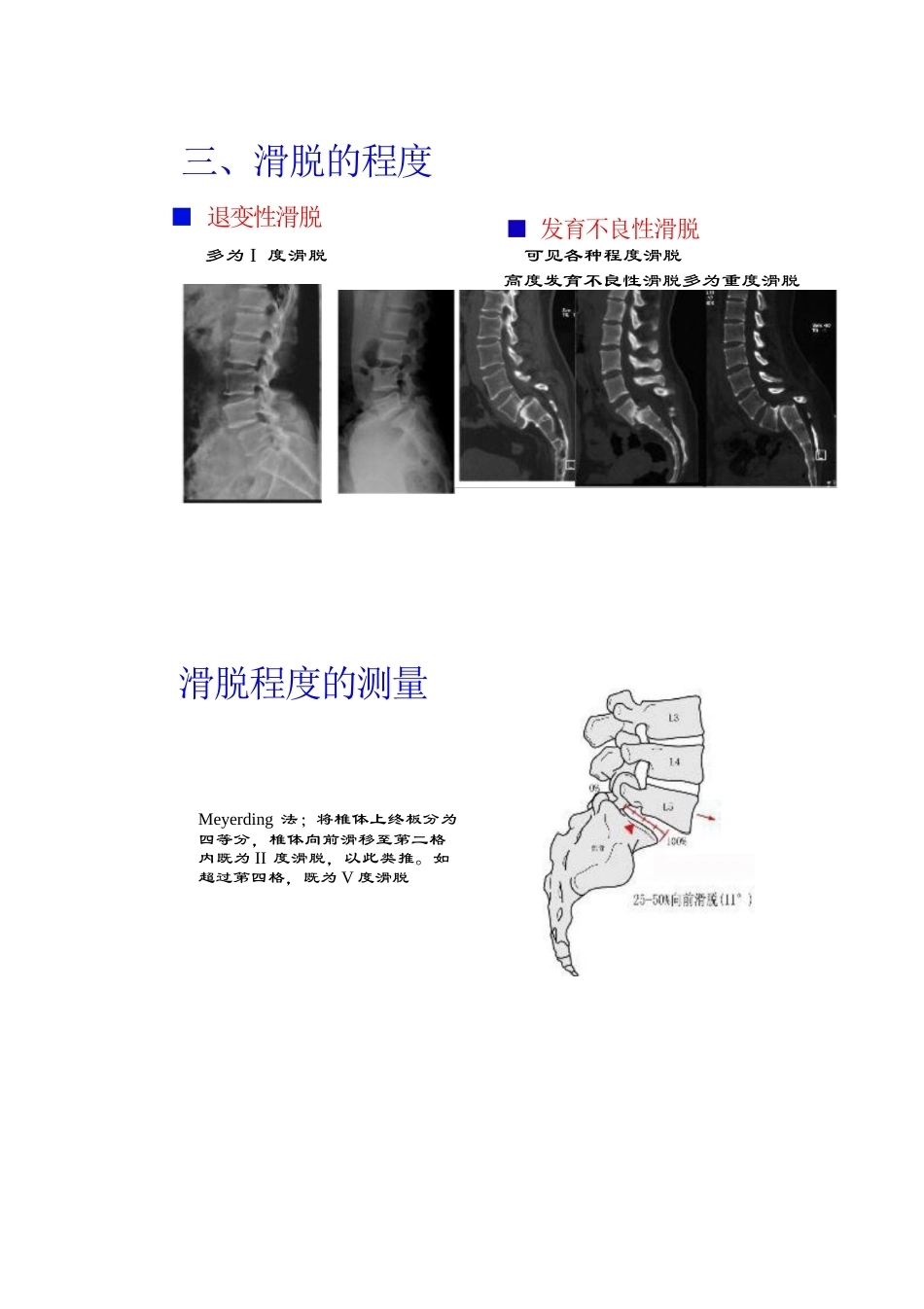 腰椎滑脱的临床分型_第11页