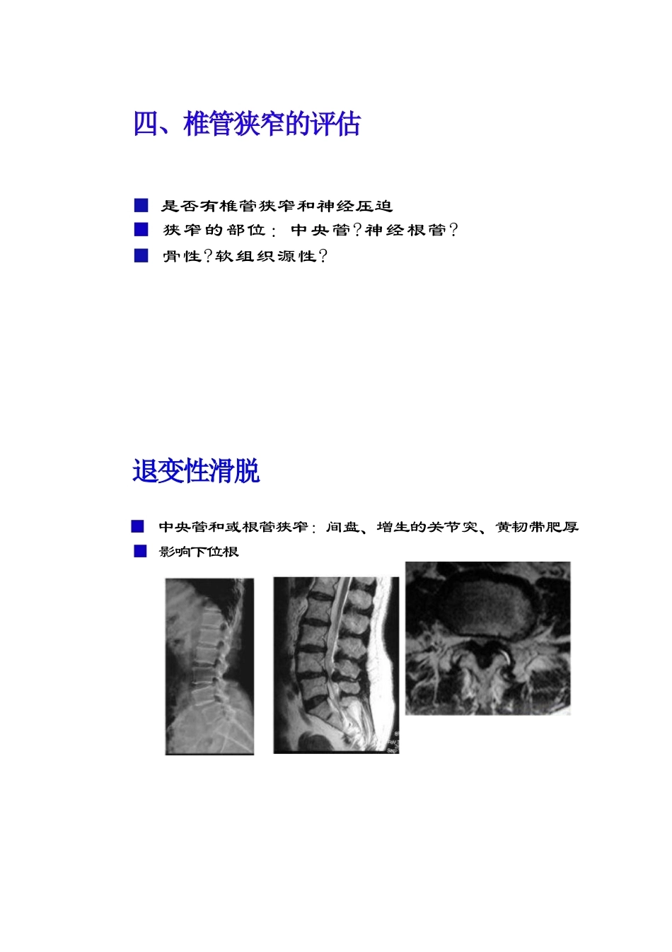 腰椎滑脱的临床分型_第13页