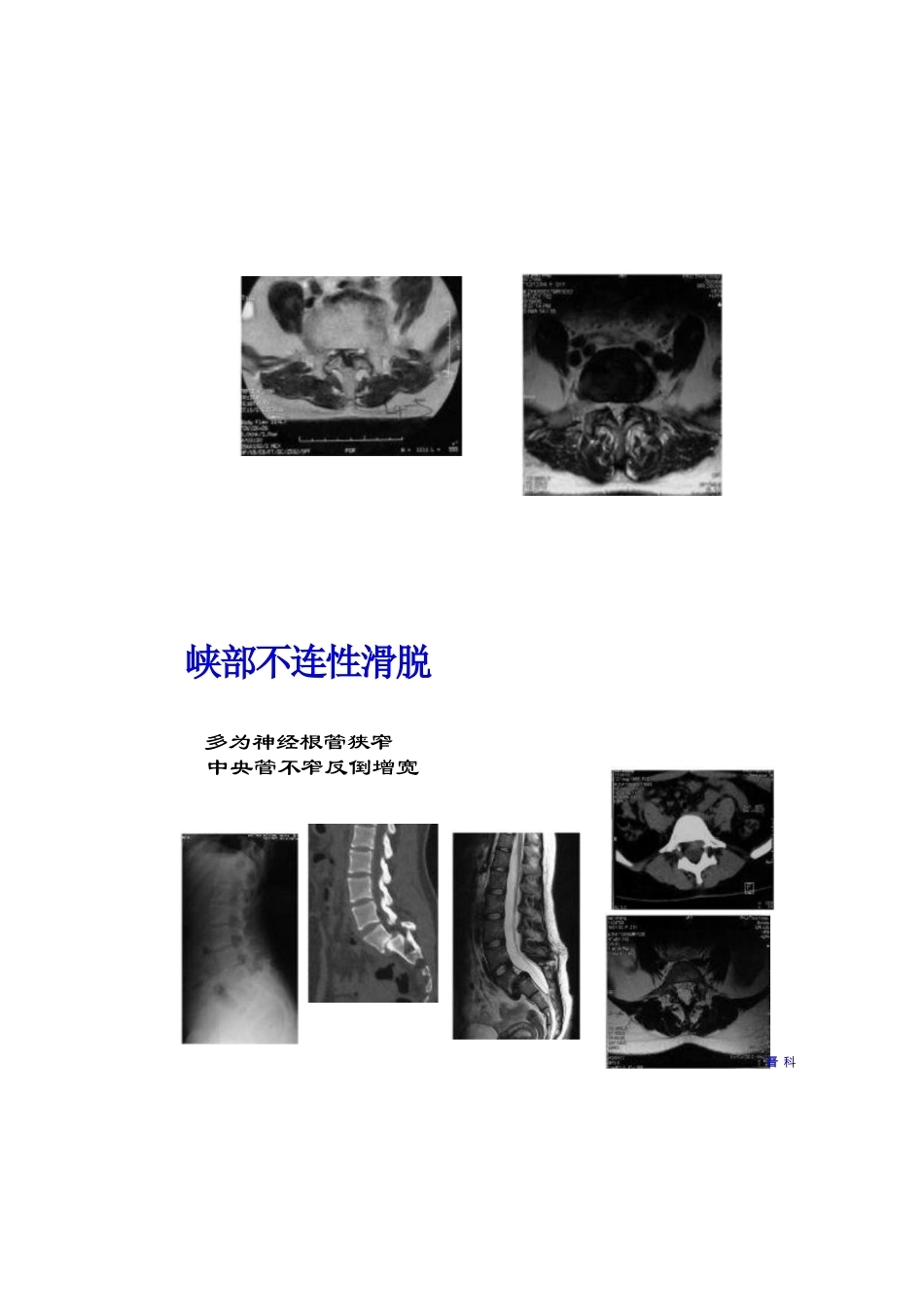 腰椎滑脱的临床分型_第14页